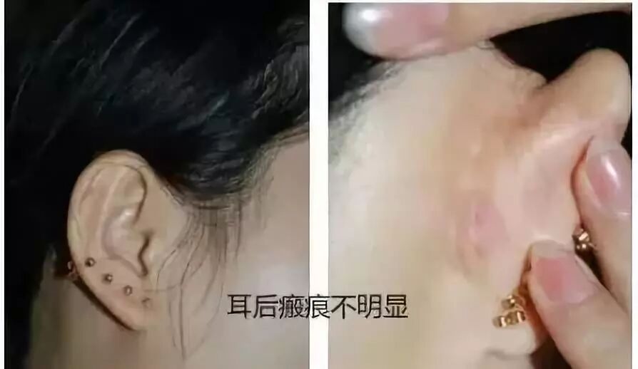 这么多种隆鼻材料，要怎么选？插图9