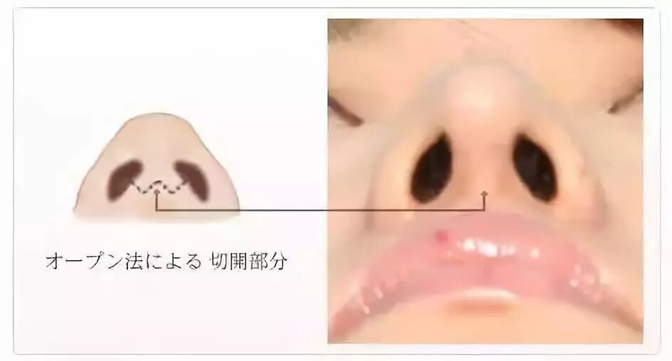 这么多种隆鼻材料，要怎么选？插图10