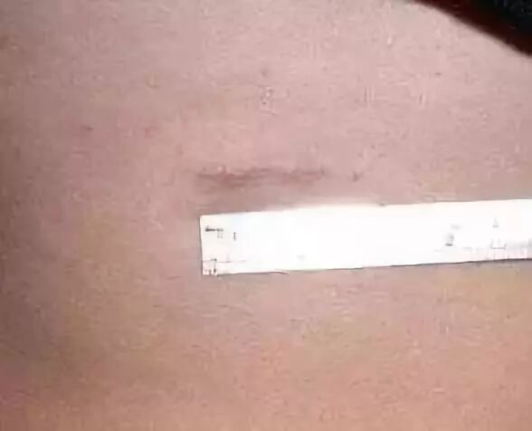 这么多种隆鼻材料，要怎么选？插图11