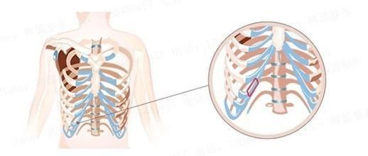不想用假体隆鼻，还可以用什么？插图