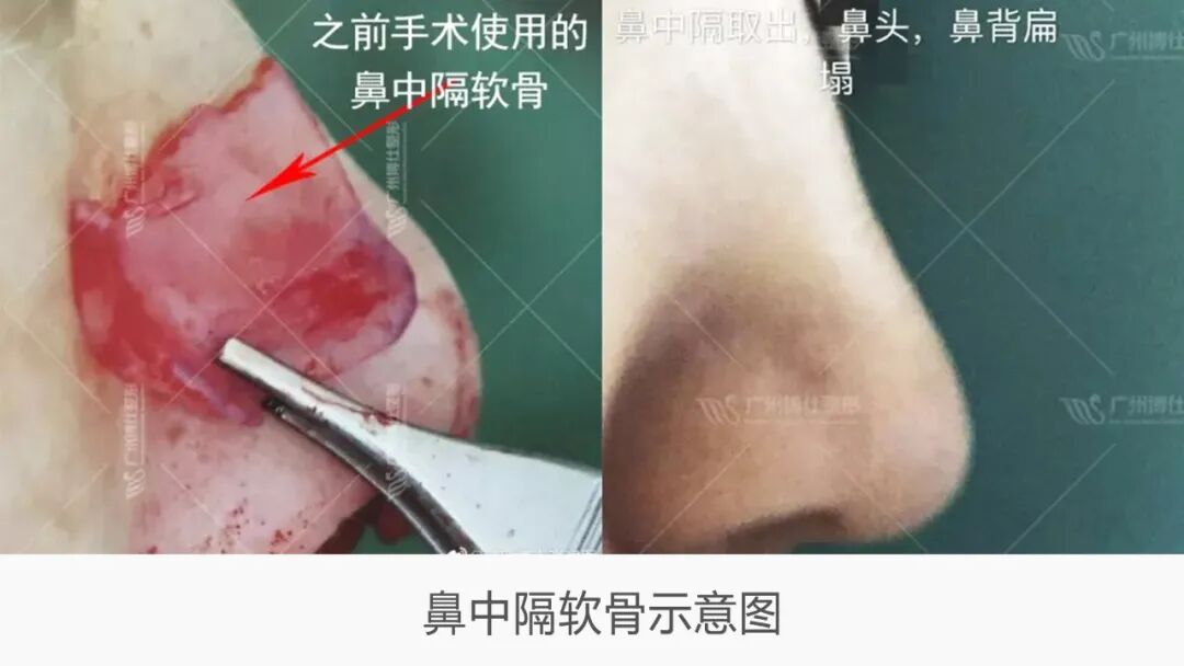 隆鼻技术 | 鼻尖整形中建议取鼻中隔软骨吗？插图2