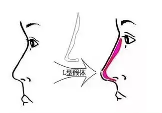 隆鼻方法这么多，到底是假体好，注射好，还是自体好?插图4