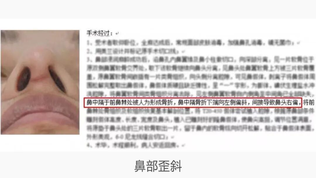 隆鼻技术 | 鼻尖整形中建议取鼻中隔软骨吗？插图3