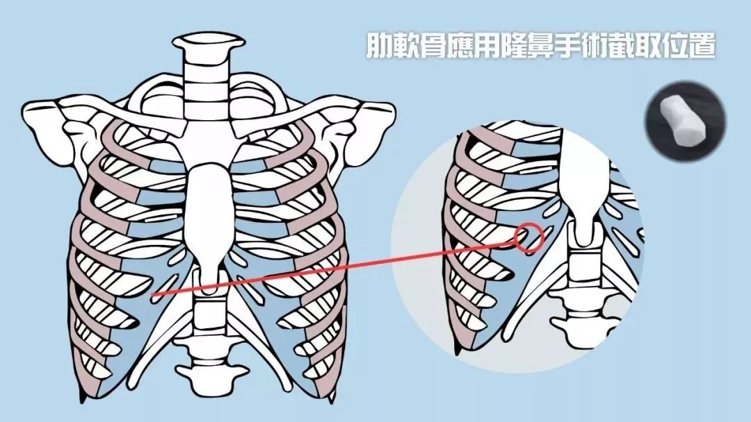 耳软骨、肋软骨、鼻中隔，用它们隆鼻有啥区别？插图1