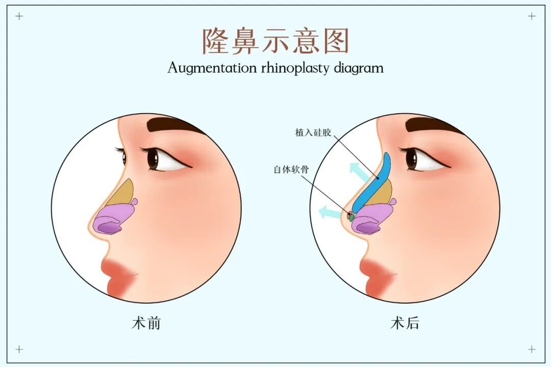 关于隆鼻术手术，你需要知道的一些知识点插图1