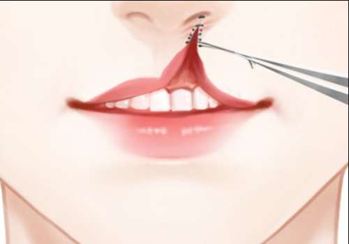 北京八大处王永前唇裂案例一览！2026真实反馈：技术稳、缝合精细！插图4