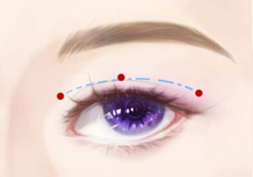 上海苏薇洁修复双眼皮怎么样？九院实力派、眼整形经验丰富/修复案例多！插图