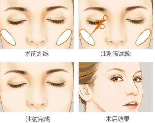 上海张余光苹果肌复位手术_九院主任技术详解，价格2.8万元起(抗衰必看)插图