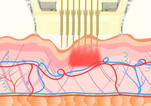 上海瑞金医院徐思嘉怎么样？黄金微针\超声炮技术好、价格便宜！插图4