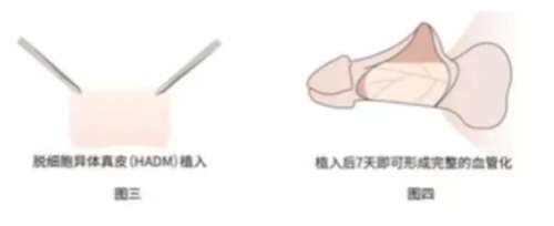 延长增粗手术郭建华医生和李世荣医生谁厉害？技术实力与口碑全面PK插图2