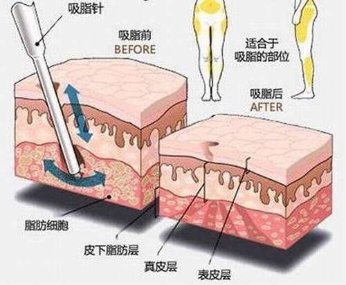 郭久璋大腿吸脂恢复期是多久？术后1~3个月基本稳定，术后3~6个月恢复好插图2