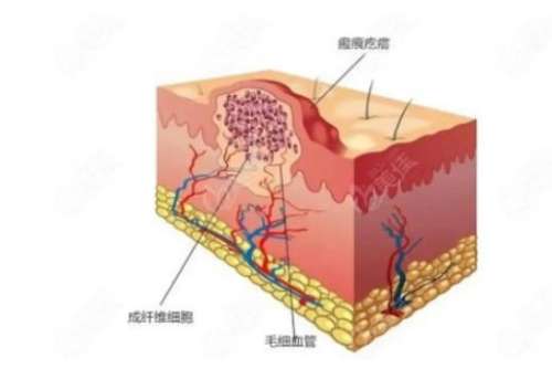上海九院武晓莉医生瘢痕治疗有何特色？瘢痕增生期综合干预与案例分享！插图2