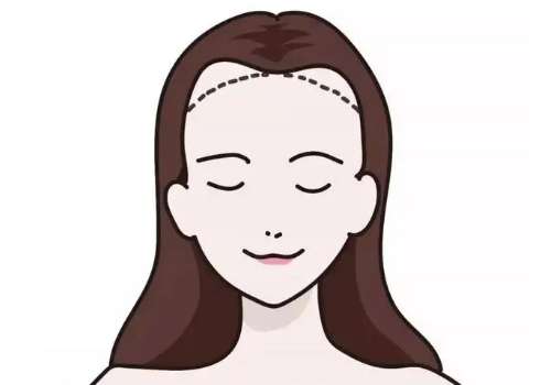 潍坊医学院附属医院植发医师有谁？牛常英领衔/fue技术_价格亲民！插图3