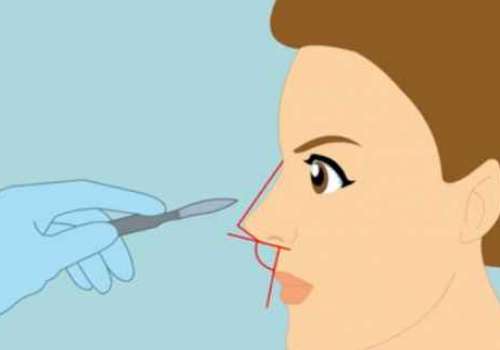 北京八大处陈光宇怎么样？隆鼻2万元起，真实案例分享插图3