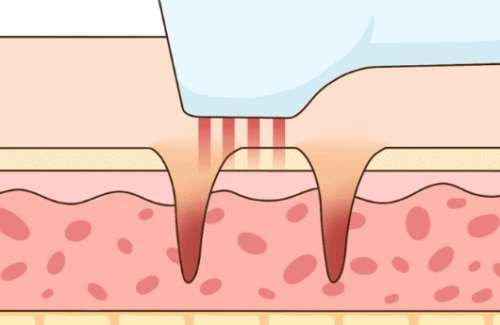 刘梅医生口碑怎么样？除皱抗衰 | 京城皮肤医院插图2