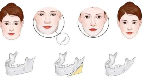 李勇辉医生口碑怎么样？下颌角整形医生推荐 | 广西爱思特整形外科医院插图3