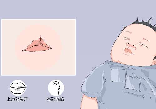 北京八大处王永前唇裂案例一览！2026真实反馈：技术稳、缝合精细！插图1