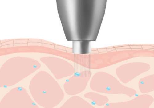 上海瑞金医院徐思嘉怎么样？黄金微针\超声炮技术好、价格便宜！插图3