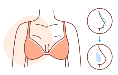 葛海辉隆胸案例深度解析：不同胸型基础、术后曲线对比与风格特点插图