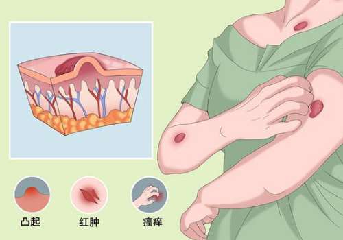 上海九院黄如林做疤痕怎么样？注射、激光、手术修复手段好插图3