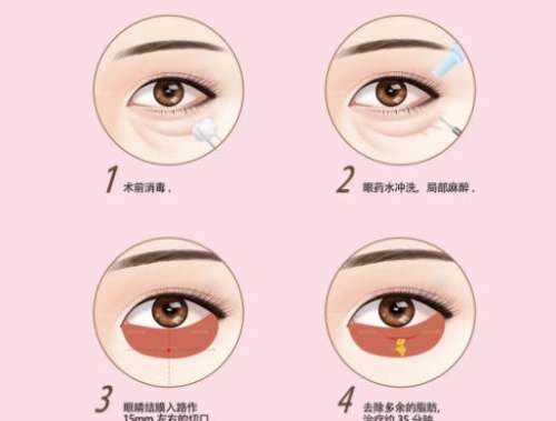 郭时伟的外切眼袋案例图展示！医生经验丰富、风格自然！插图2