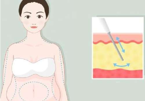 成都抽脂赵兴阳资料分享！医生口碑技术点评！戳进来看插图1