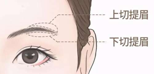 新疆威兹曼整形外科医院刘丽娜提眉怎样？医生简介|网友真实评价！插图1