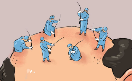 上海植发医生余新明：技术优势、案例展示、预约方式插图2