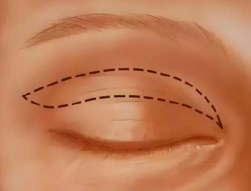 浙二做双眼皮有名医生有哪些？包祺、黄成以及李楠技术一一了解插图4