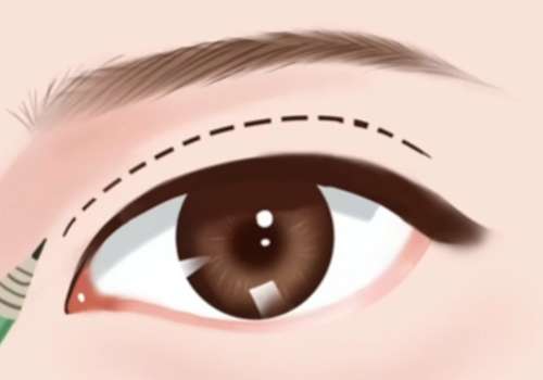 成都王小彦医生口碑如何？双眼皮修复满意度高、审美多元、技术稳！插图4