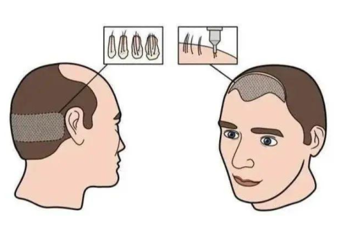 杭州张菊芳个人资料简介-发际线种植风格-2026年最新价目表流出插图2