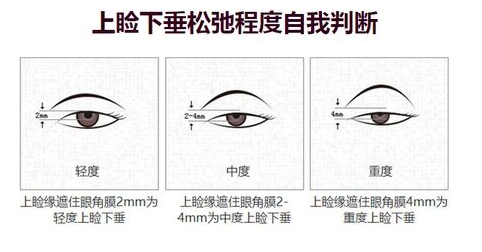成都何珊珊医生怎么样？擅长精细化眼部整形，术后恢复快插图