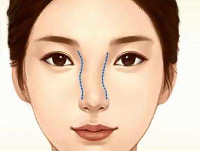 张洪波医生口碑怎么样？胸部整形医生推荐 | 上海光博士插图1