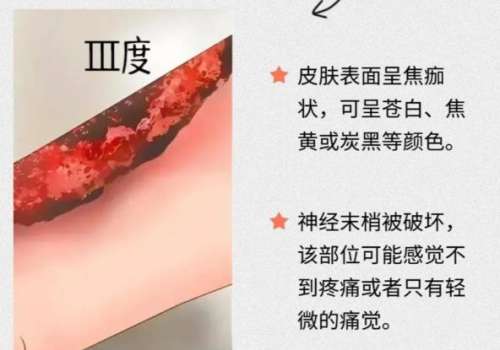 上海九院章一新医生擅长哪些瘢痕修复？显微外科联合放疗治疗瘢痕疙瘩！插图1