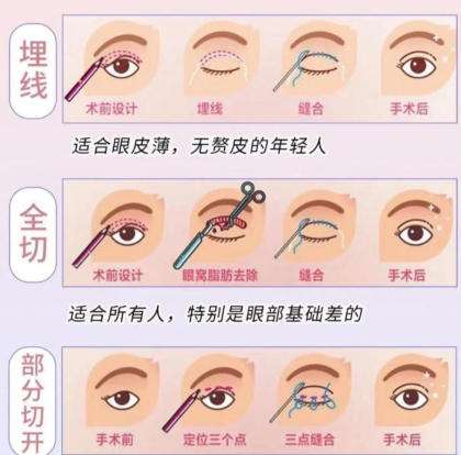 上海九院冯少清修复双眼皮吗多少钱？经典案例展示！含价格表插图1