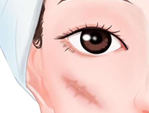 上海九院陈立彬医生瘢痕治疗优势是什么？术后瘢痕管理及抗增生方案！插图1