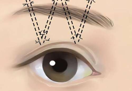 新疆威兹曼整形外科医院刘丽娜提眉怎样？医生简介|网友真实评价！插图2