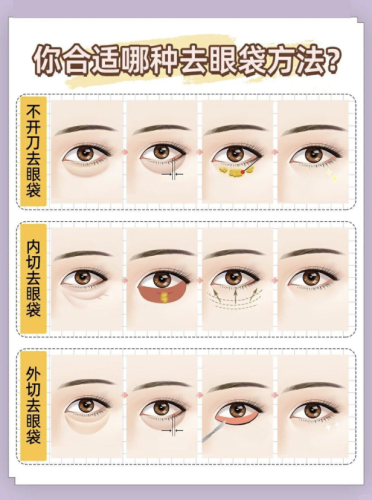 福州去眼袋好的医生：榜单公开，各有专长，按需 Pick插图