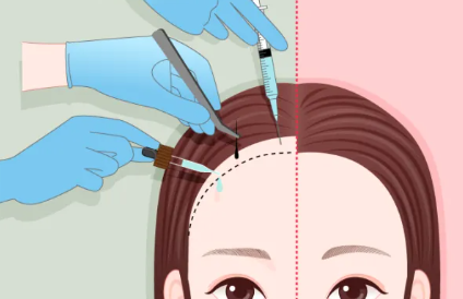 上海植发医生薛栋 · 坐诊信息、擅长领域、网友真实评价插图1