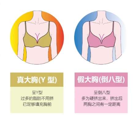 陈智医生口碑怎么样？胸部整形医生推荐 | 脂管加吸脂塑形插图4