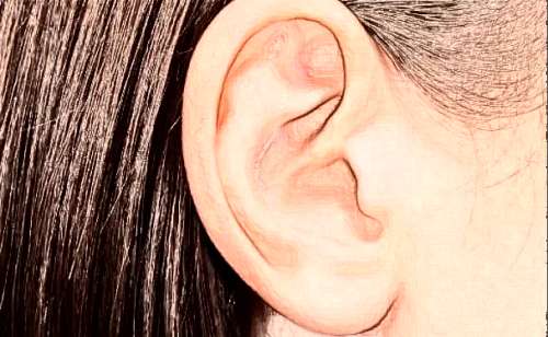 河北省儿童医院张蕴珍招风耳整形90天野生案例(效果怎么样?技术评测)插图2