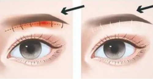 武汉协和医院提眉医生排名！热门专家盘点，技术优势与价格参考插图1