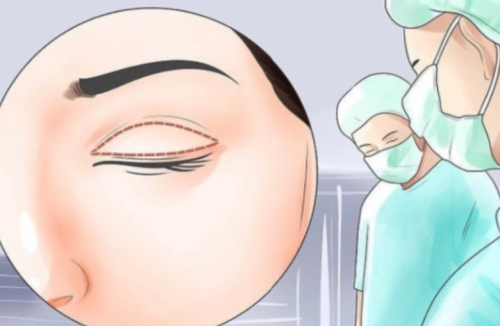 裴旭芳双眼皮案例鉴赏，不同眼型改造前后对比，看看有没有你的同款插图