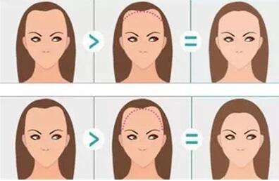 上海华美植发怎么样？连锁医美头发种植技术、价格、案例全扒皮插图1