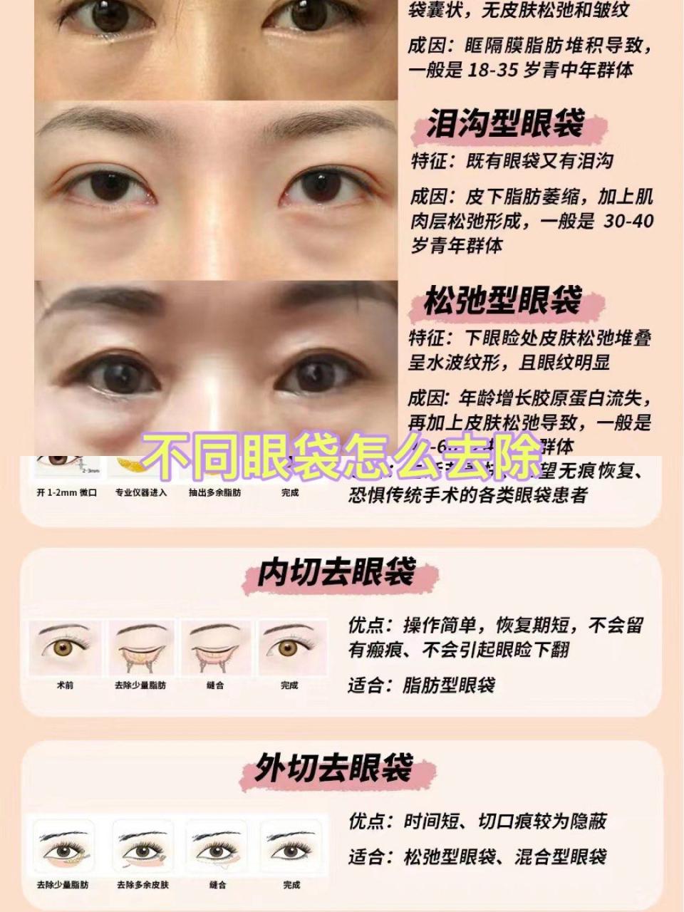 如何选择靠谱的机构进行超声法去眼袋？