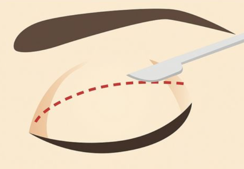 武汉王海平修复双眼皮怎么样？高难度修复强，术后反馈好插图1