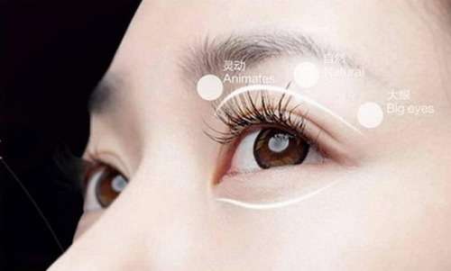 郑州人民医院王剑做双眼皮怎样？精细化缝合、微创操作、术后自然插图2