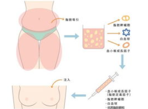 长沙吸脂专家有哪些？医生体型设计风格与价格透明化展示插图