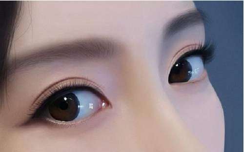 北京李燕双眼皮审美怎么样？自然审美路线，附技术分析插图