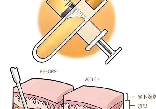 北京朱金成做脂肪填充好吗？技术/实力/口碑都不错插图2